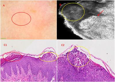 Case report: Infantile generalized pustular psoriasis with IL36RN and CARD14 gene mutations